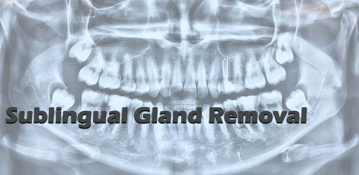 Sublingual Gland Removal